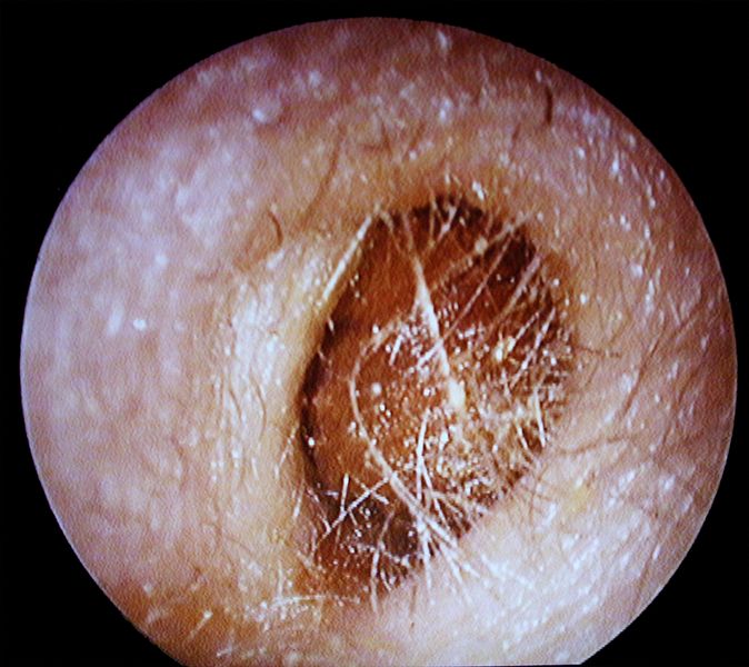 Comment enlever un bouchon d'oreille avec une poire ?